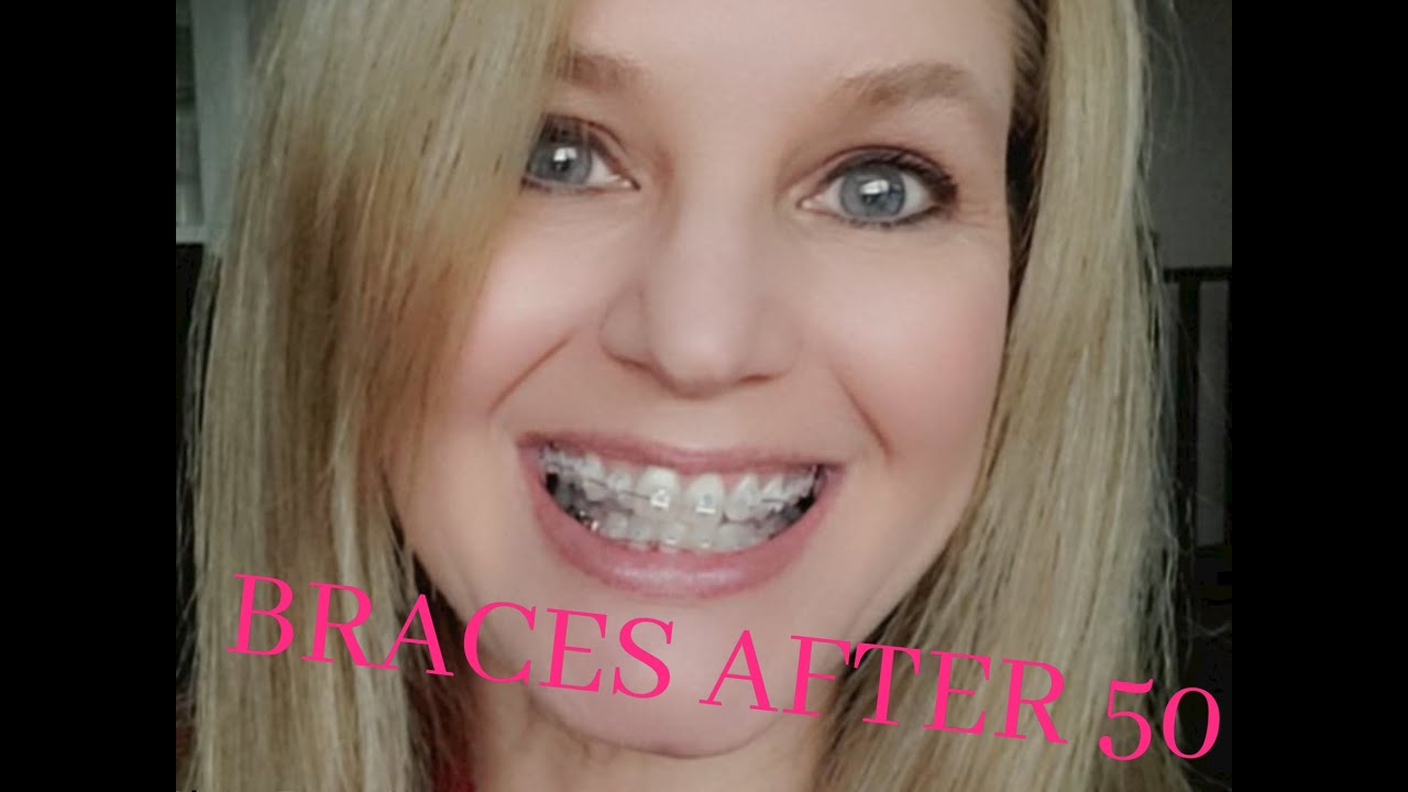 Why I got braces after 50 YouTube