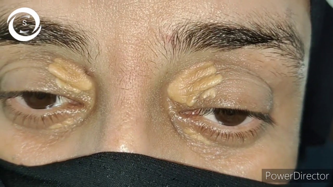 Xanthelasma palpebrarum