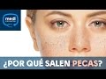 ¿Por qué salen pecas en la piel? #MediConsultas