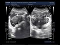 Ultrasound Video showing A rare case, Ruptured ectopic Pregnancy, tubal pregnancy.