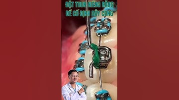 Video quá trình đặt thun niềng răng để cố định dây cung | Bác sĩ Cường #bacsicuong #shorts