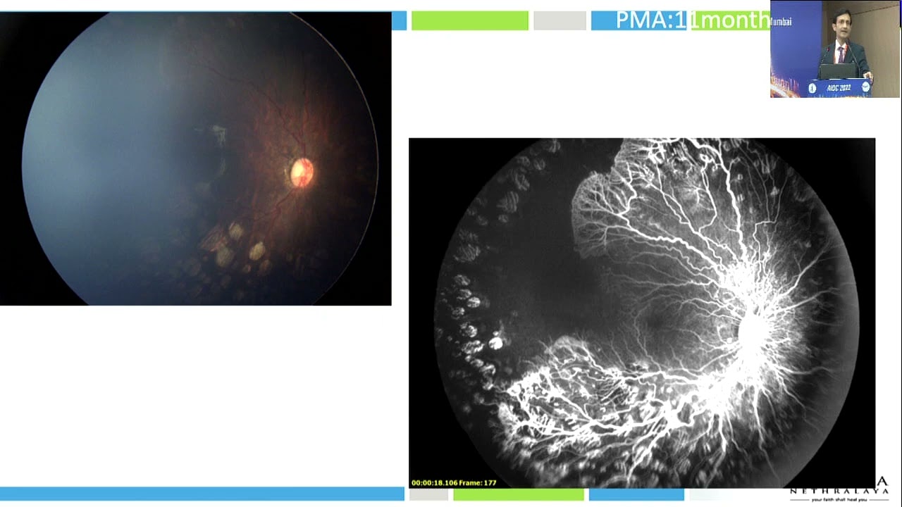 AIOC2022 GP94 topic Dr  ANAND VINEKAR What’s new in ROP