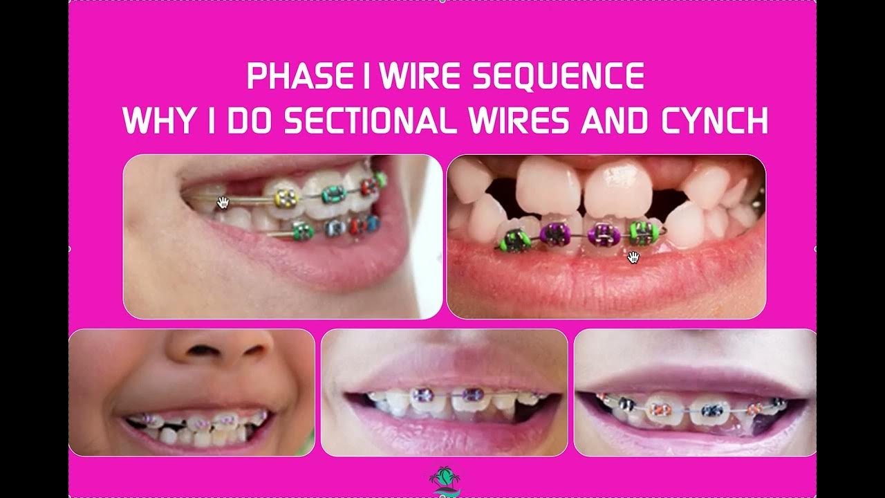 Phase 1 Braces, Wire Sequence Cynch, Sectional Wires YouTube