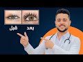 سر تطويل الرموش والحواجب النتيجه بتظهر خلال ايام تطويل الرموش