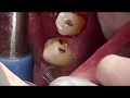 上尾 歯医者 歯茎の下に潜む歯石取り パート2 Invisible tartar under the gums