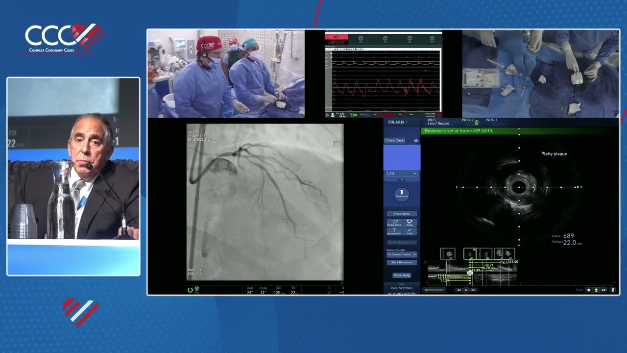 LIVE CASE  1 - IVUS-Guided PCI of Ostial LM and Mini-Crush LAD/D1 Bifurcation with Rota