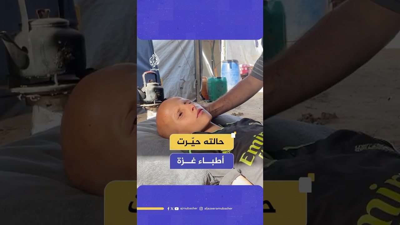 حيّر الأطباء.. طفل فلسطيني يصاب بمرض غامض طرحه بالفراش وأسقط شعره كله