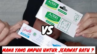 Battle Acnes Sealing Jell VS Verile Acne Gel || Gisti Prilastri