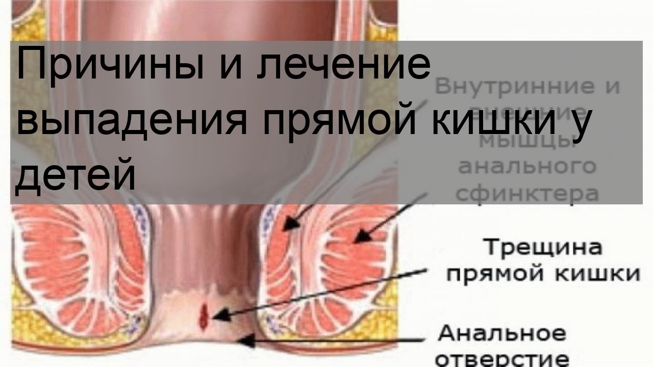 Причины и лечение выпадения прямой кишки у детей