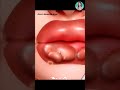 Satisfying Lip Detox ASMR 👄✨ Extreme Pimple &amp; Gloss Transformation #asmr  #fyp #viral #lipcare