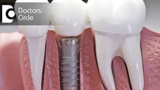 How long should one wait after tooth removal to get a Dental Implant? - Dr. Sudhakara Reddy