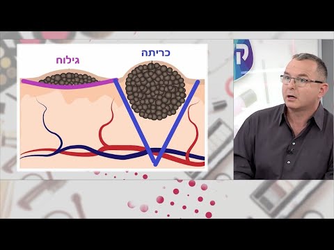 וִידֵאוֹ: האם שומות א-סימטריות יכולות להיות שפירות?