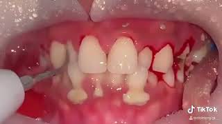 чистка зубов от зубного камня
