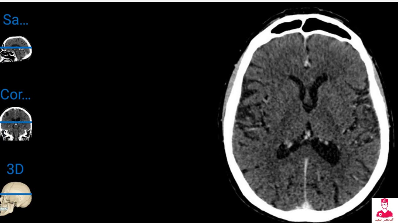 تشريح إشعاعي || أشعه مقطعيه علي المخ Radiological anatomy of the brain ...
