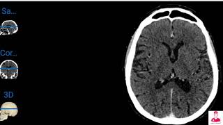 تشريح إشعاعي || أشعه مقطعيه علي المخ Radiological anatomy of the brain screenshot 4