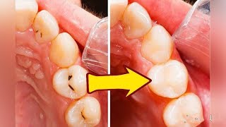وصفات /نصائح / وطريقة ازالة تسوس الاسنان بدون الذهاب الى الطبيب