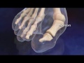 Hallux Valgus Surgery - YouTube