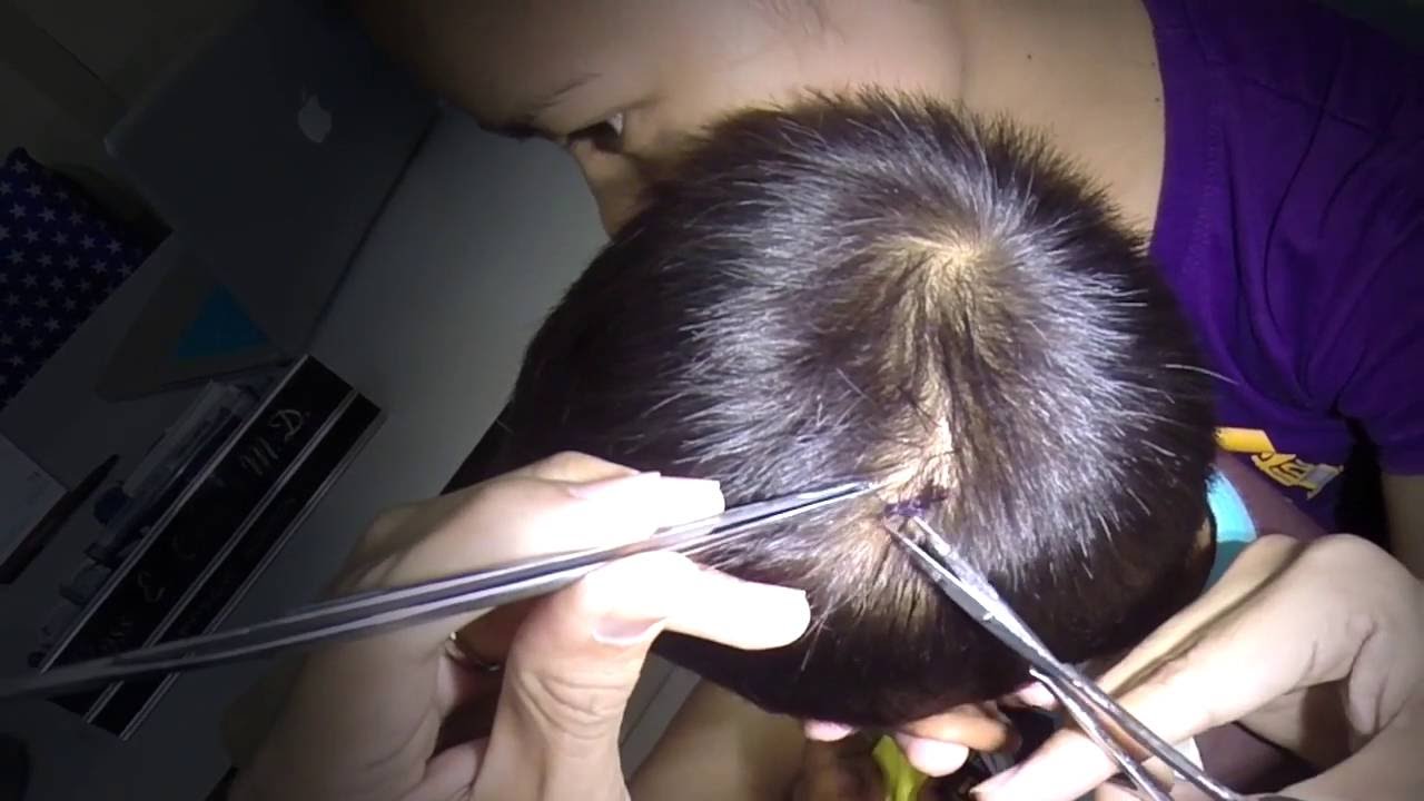 removal-of-suture-in-the-scalp-of-a-3y-o-boy-youtube