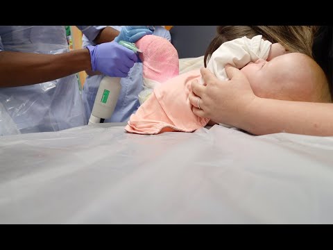 9 MONTH OLDS REACTION TO HAVING SPICA CAST REMOVED | DDH (DEVELOPMENTAL DYSPLASIA OF THE HIP)