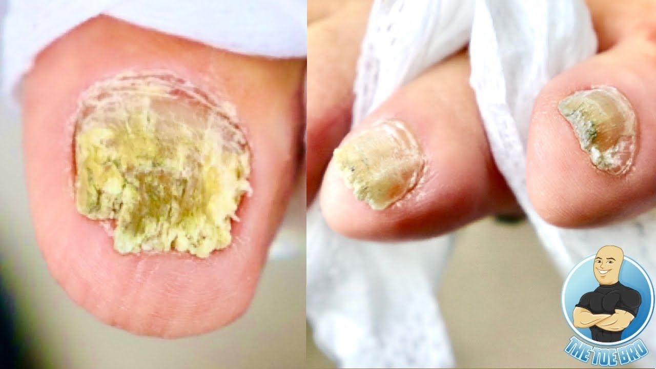 Staying one step ahead of toenail fungus - Harvard Health