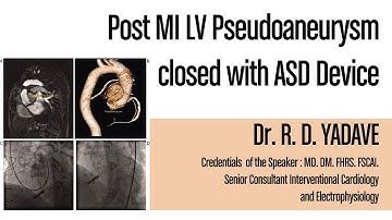 Post MI LV Pseudoaneurysm closed with ASD Device