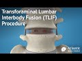 Transforaminal lumbar interbody fusiontlif procedure