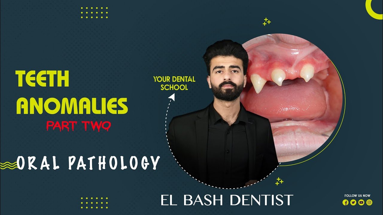 developmental anomalies || teeth anomalies 2 || oral pathology _عزت شومان