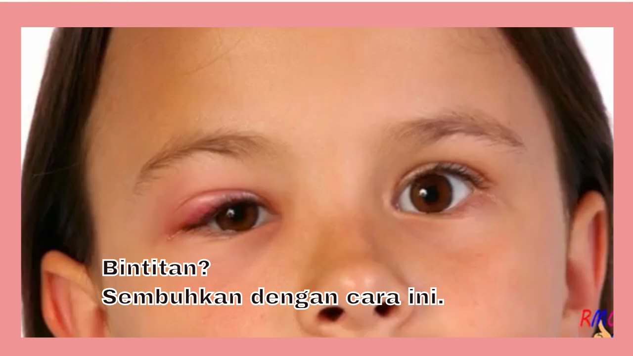 BINTITAN! | Bagaimana Cara Mengatasi Benjolan di Kelopak Mata?