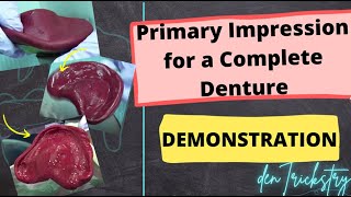Primary Impression for a Complete Denture - Demonstration (Super Simple)