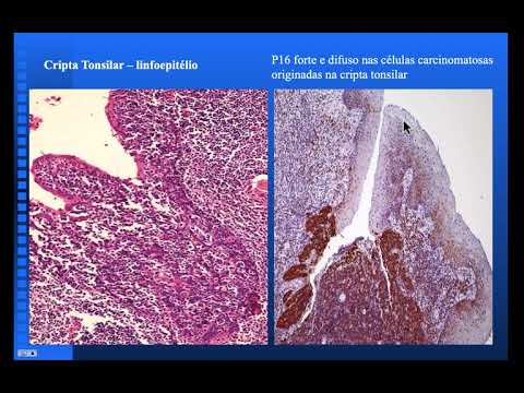 Vídeo: Resposta Ao R-CHOP No Carcinoma Espinocelular Da Base Da Língua Relacionado Ao HPV: Relato De Caso