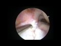 Acl reconstruction by dr anant joshi