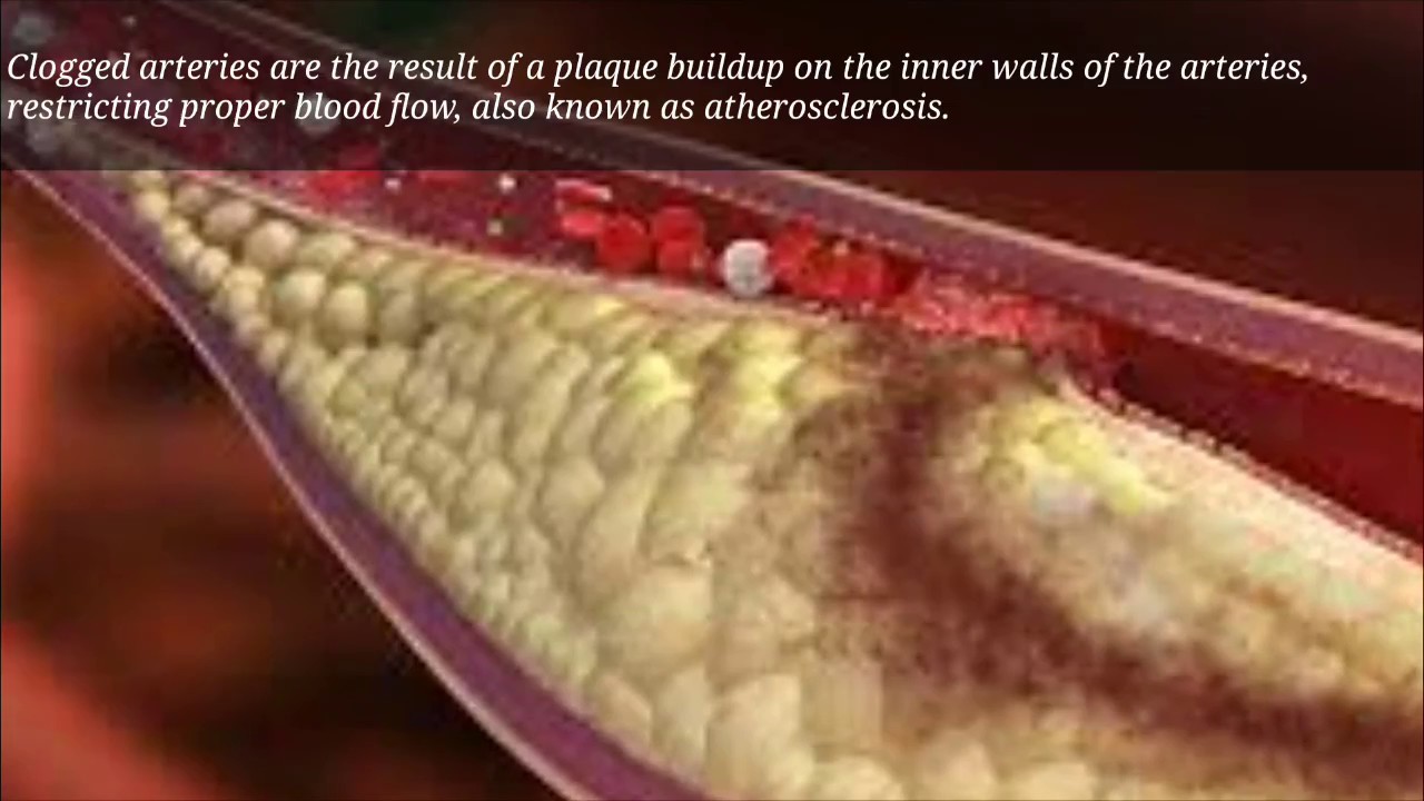 how to remove plaque from arteries mayo clinic