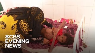 Children In Yemen Are Starving To Death And Struggling Without Medication