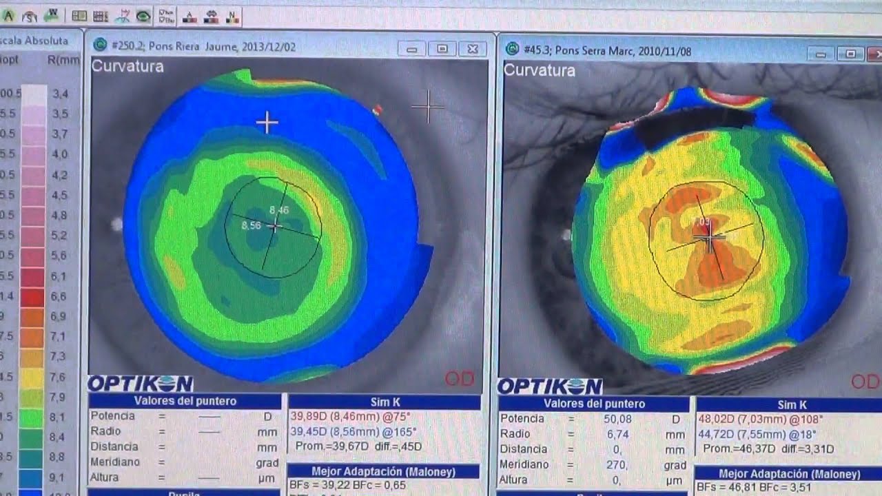 Control de miopía Últimos avances