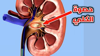 شاهد كيف يتم تفتيت حصوه الكلي باستخدام المنظار-Removal of kidney stones