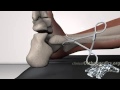 Operative Behandlung von Frakturen Knöchel