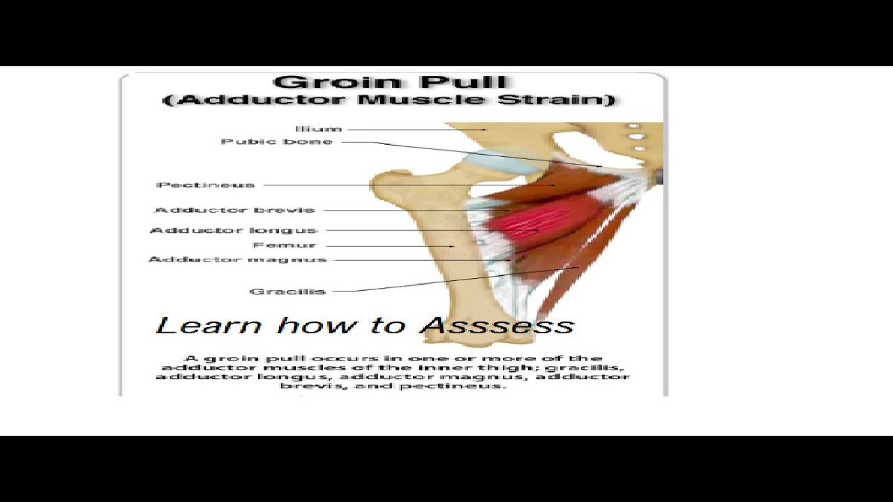 Groin injury Groin pain Assessment Diagnosis Part 1 and part 2