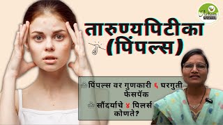 Pimples |तारुण्यपिटीका पिंपल्स | पिंपल्स वर गुणकारी ६ फेसपॅक