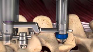 Spine Wave: Annex® Adjacent Level System