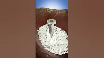 How Dental Implants Work 🤔