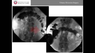 Urinary Diversion Surgery