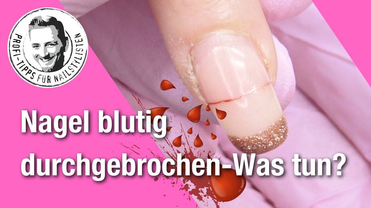 Grüner Nagel Unter Kunstnagel Was Tun Gelnägel blutig abgerissen!!! - YouTube