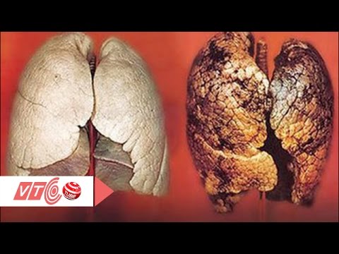 Ung thư phổi: Đừng trị bệnh khi quá muộn | VTC
