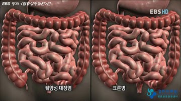 EBS명의 김효종교수님 (염증성장질환, 크론병, 궤양성대장염)