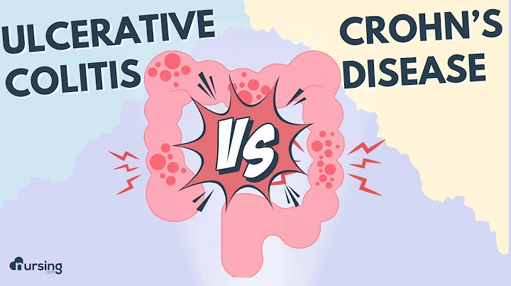 Inflammatory Bowel Disease- Ulcerative Colitis vs. Crohn's Disease