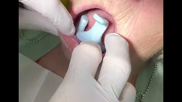 How to check extension of your custom tray (lower arch)