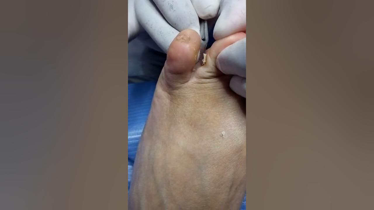 Extracción de Helomas interdigital (uso del punto de apoyo) - YouTube