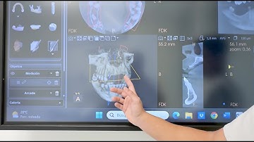 Bone Regeneration with Titanium Mesh: More bone, more possibilities
