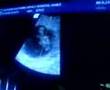 8 week pregnancy heartbeat