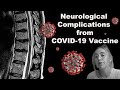 COVID-19 Vaccine | Neurological Complication